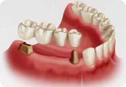 Fixed Bridge for Multiple Teeth